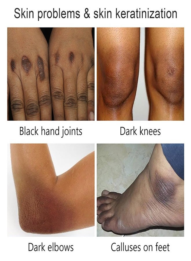 Grospe Yellow Peeling Oil, Exfoliating Chemical Peel At Home for Hand, Body and Foot Peel, Extra Strong Exfoliant Peeling Oil for Dark Skin Extra Strength All Skin Type 3.38 Fl Oz - Image 2